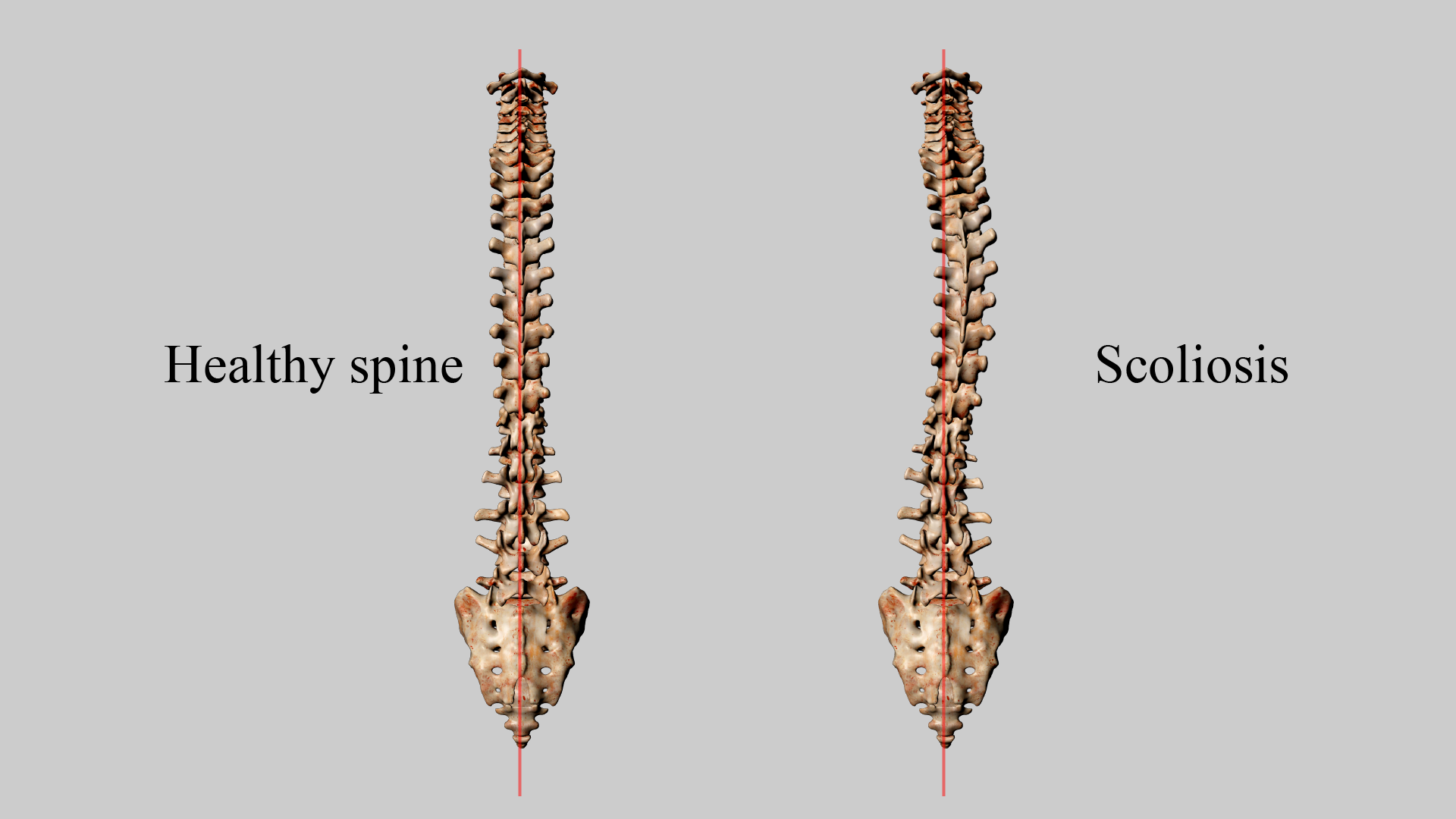 Understanding and Managing Scoliosis: From Diagnosis to Treatment