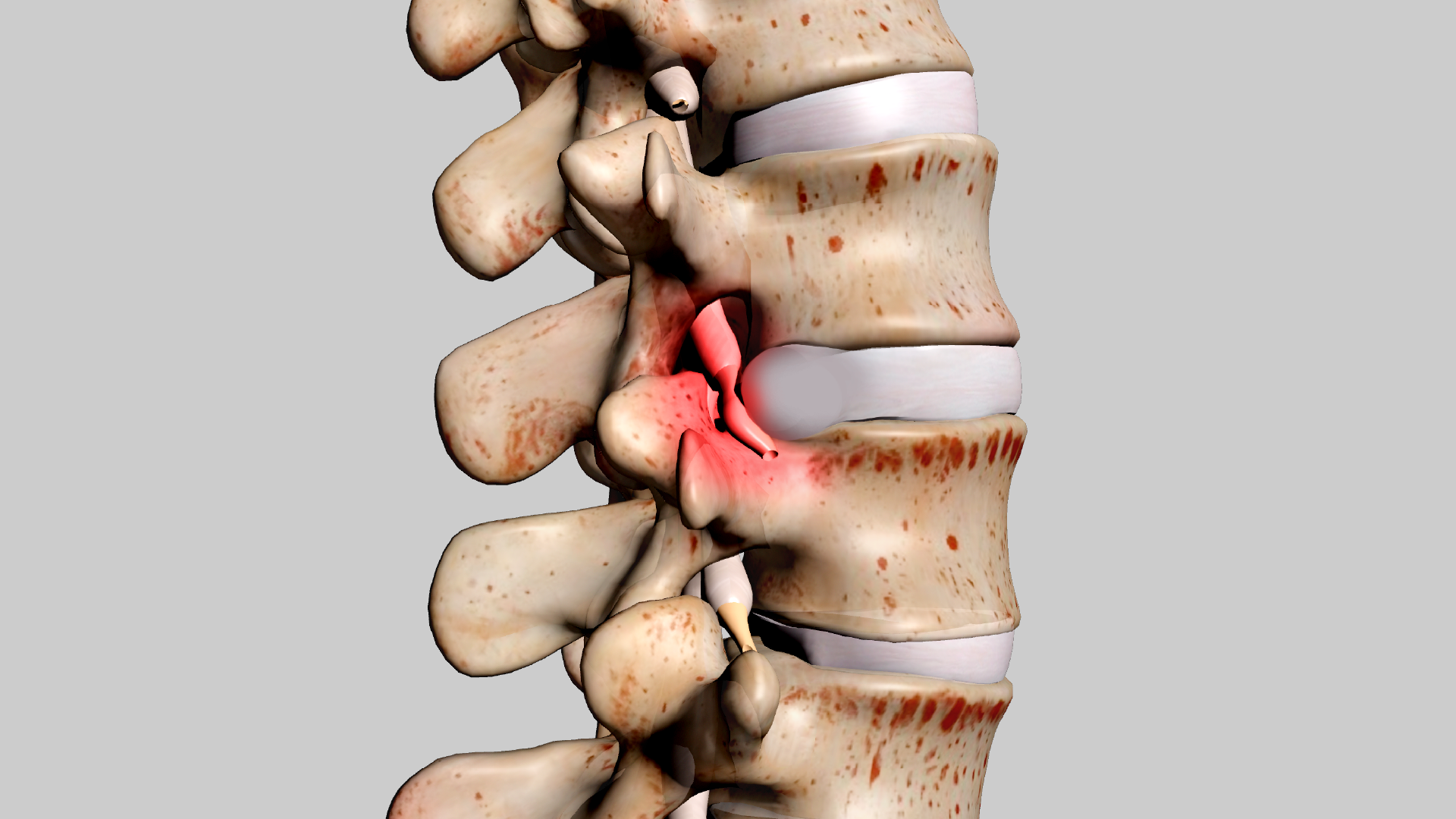 Herniated Disc: Symptoms, Causes, and Treatment