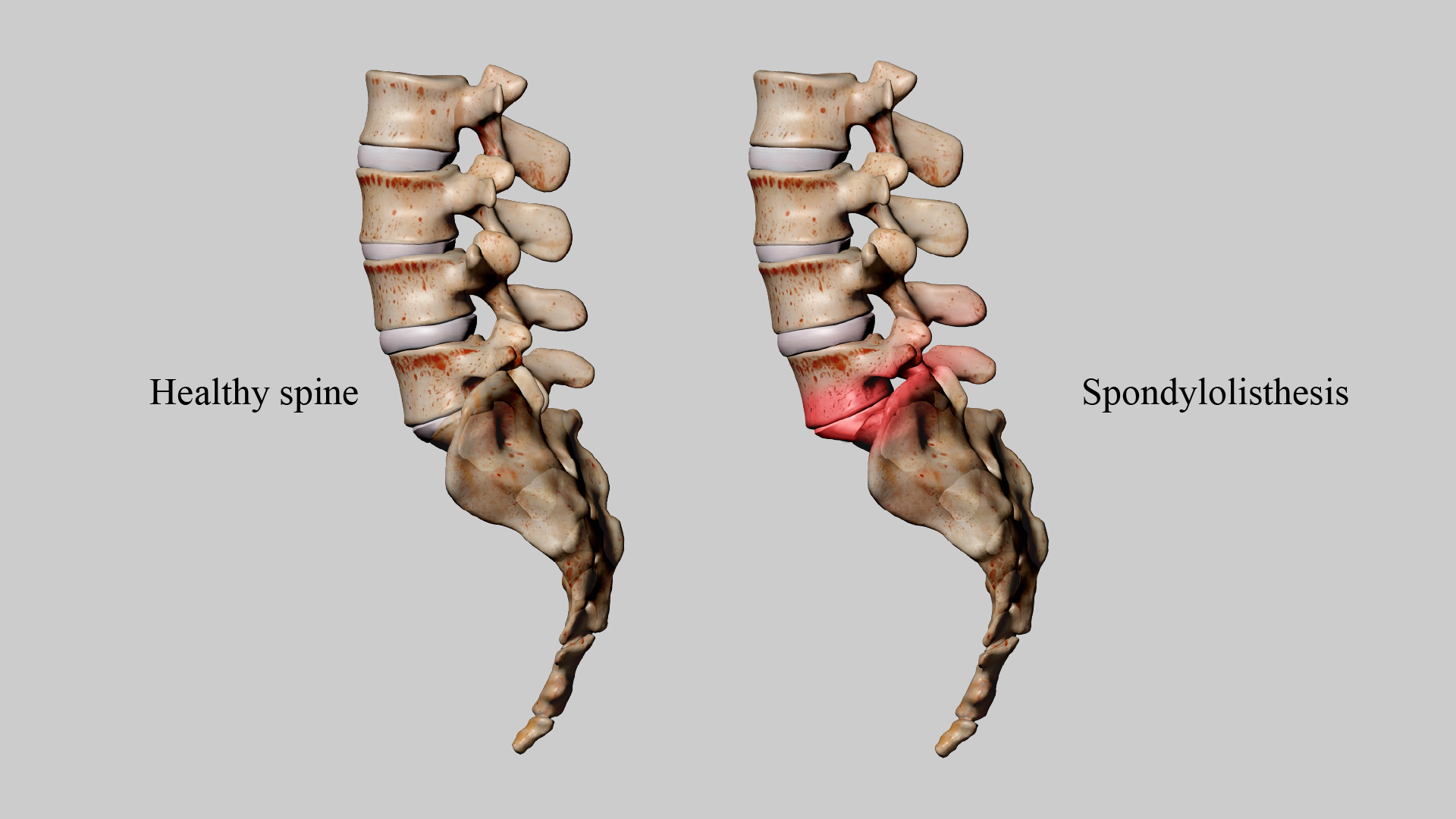 Spondylolisthesis