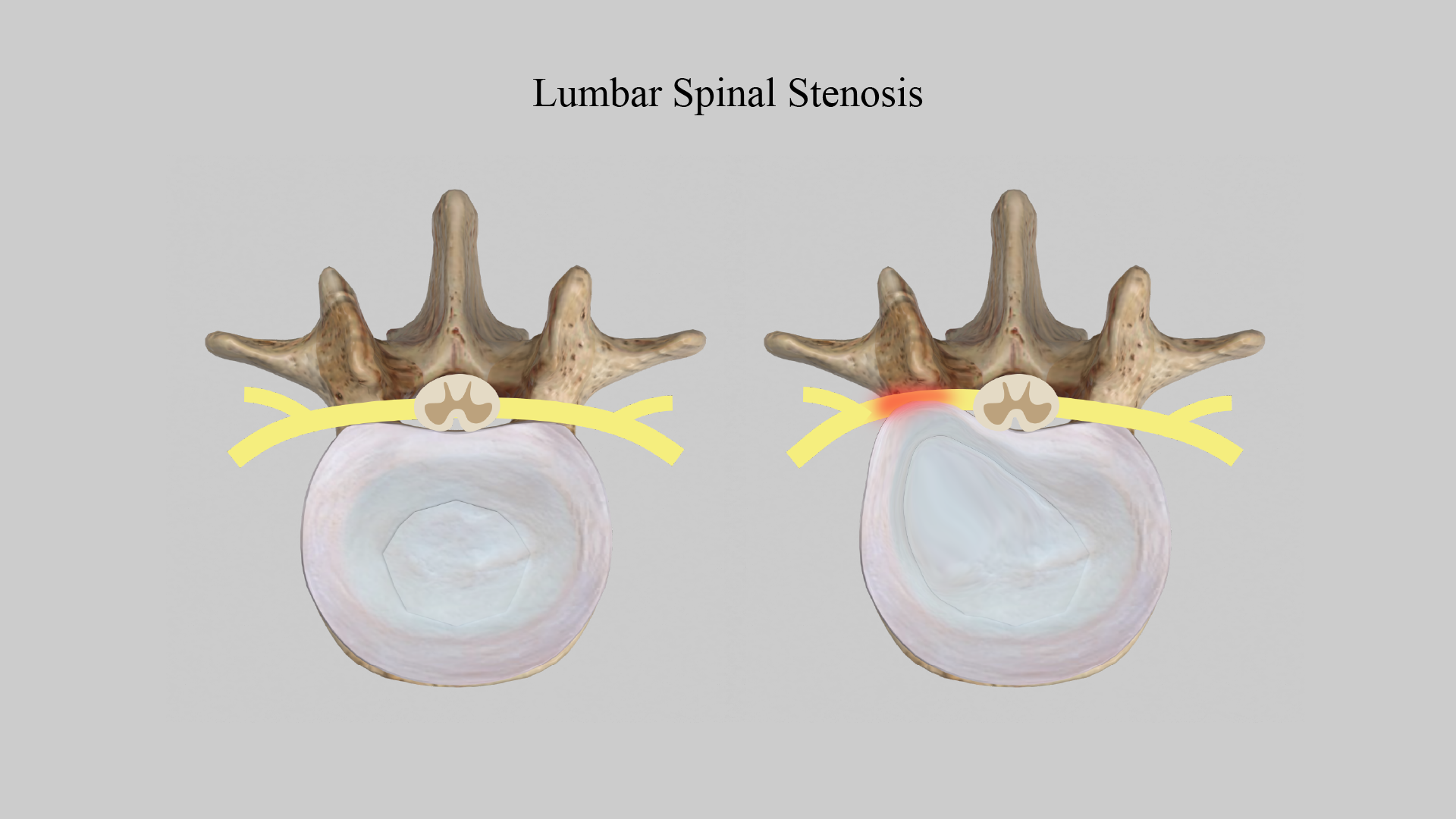 Spinal Stenosis: Comprehensive Analysis of Causes, Symptoms, and Treatments
