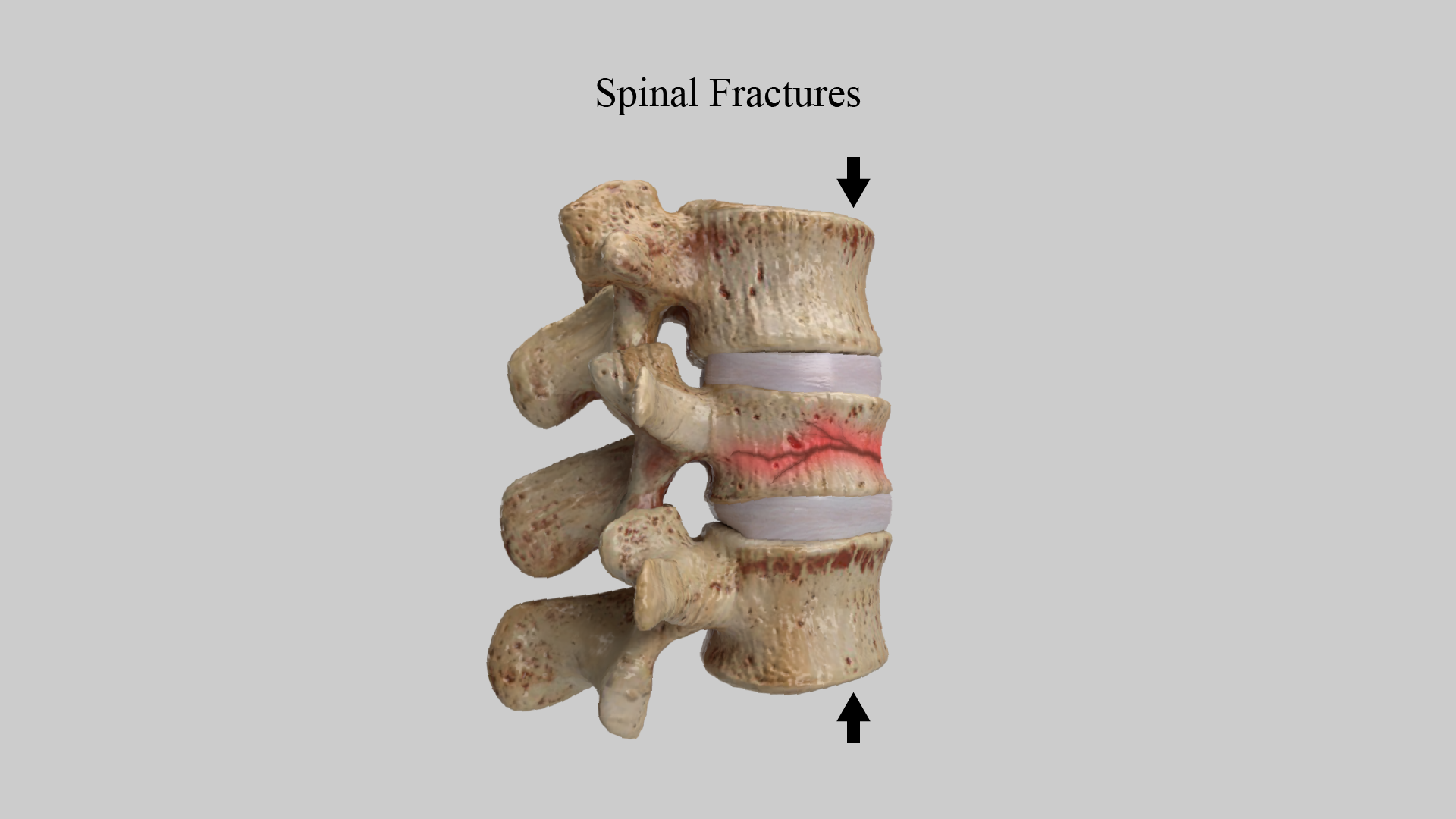 What You Need to Know About Spinal Fractures